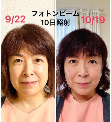 目袋が小さく＆ほうれい線も薄くなって嬉しい！